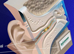 Folding Catheter